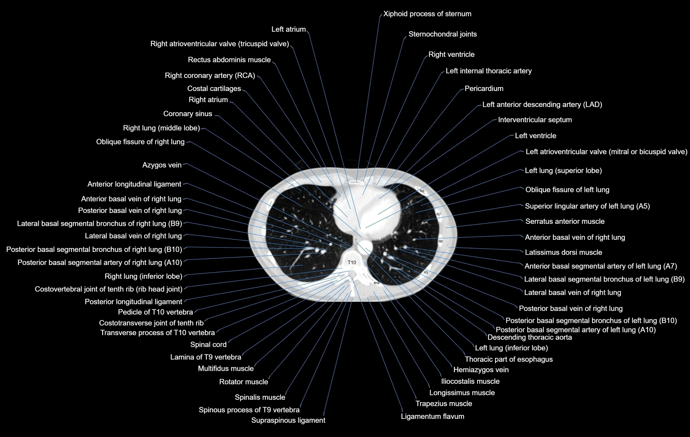 CT chest (thorax) lung window window labelled axial cross sectional anatomy radiology image-00085.webp